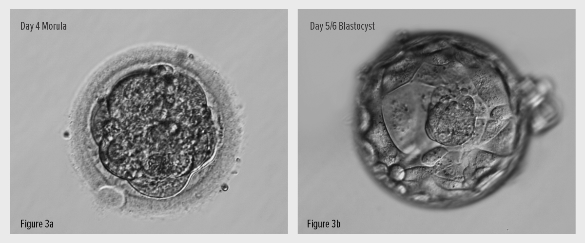 Fig. 3 - IVF Blastocyst